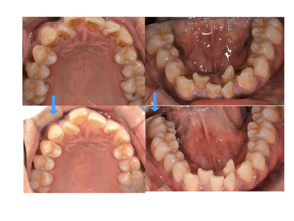 港南台パーク歯科クリニック｜【症例】ステイン除去を希望された患者様へのクリーニング｜クリーニング前後の比較写真