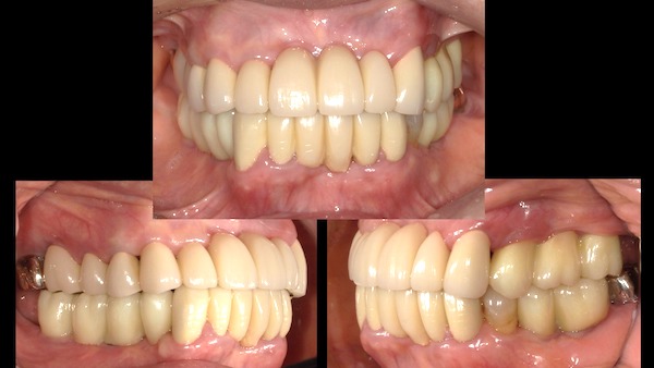 港南台パーク歯科クリニック｜ブログ症例｜歯周病で入れ歯になった患者様の噛み合わせ・見た目の回復｜治療後画像7