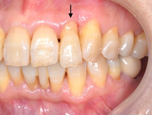 港南台パーク歯科クリニック|ブログ｜症例｜【症例】歯周病で溶けた骨を再生する治療（エムドゲイン・Bio-Oss）｜治療前の歯茎の画像_画像2
