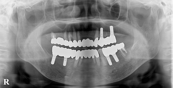 港南台パーク歯科クリニック｜ブログ症例｜歯周病で入れ歯になった患者様の噛み合わせ・見た目の回復｜治療後画像8