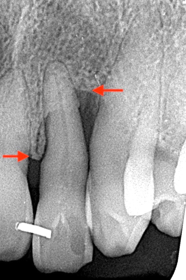 港南台パーク歯科クリニック|ブログ｜症例｜【症例】歯周病で溶けた骨を再生する治療（エムドゲイン・Bio-Oss）｜治療前のレントゲン画像_画像3