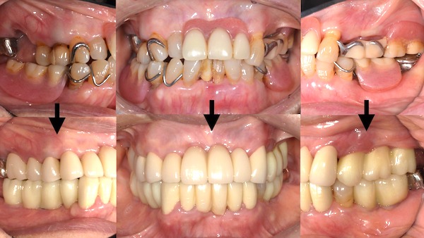 港南台パーク歯科クリニック｜ブログ症例｜歯周病で入れ歯になった患者様の噛み合わせ・見た目の回復｜タイトル画像1