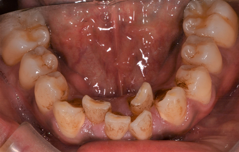 港南台パーク歯科クリニック｜【症例】ステイン除去を希望されたクリーニング ｜治療前の口腔内写真（下顎）
