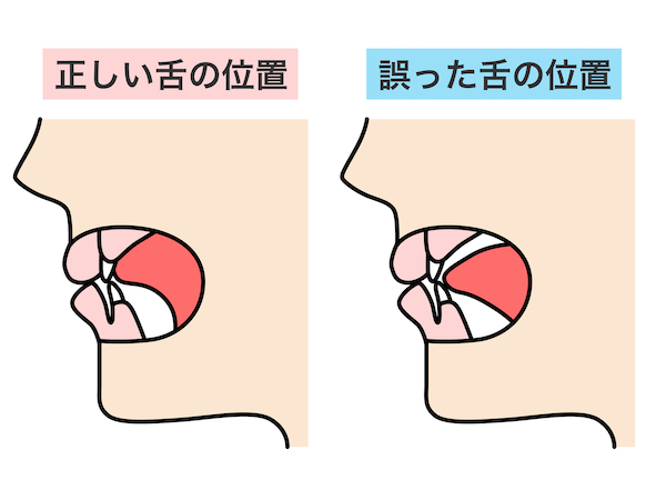 港南台パーク歯科クリニック｜ブログ｜MFT（口腔筋機能療法）とは？トレーニング法も紹介｜舌の位置の画像