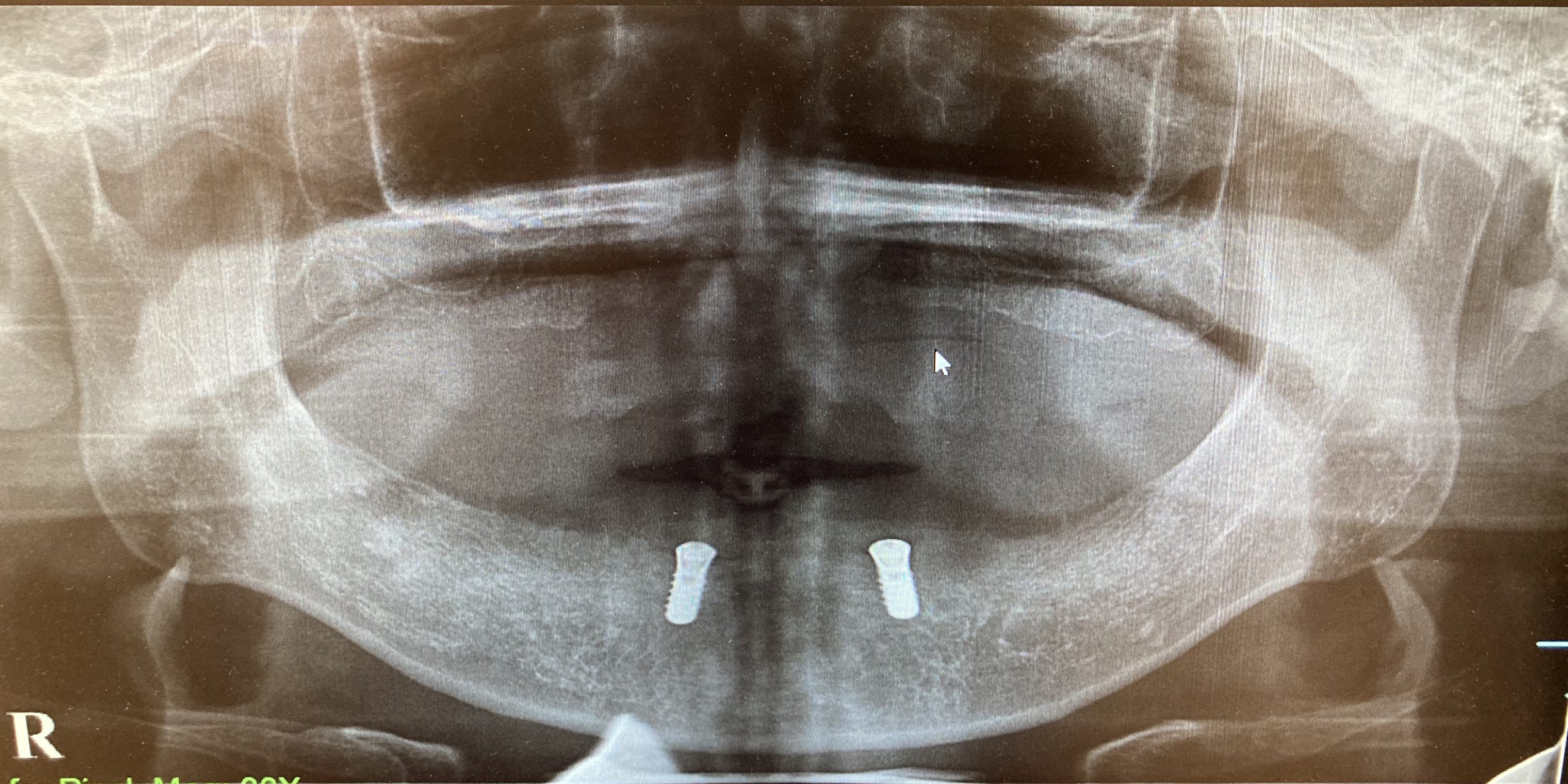 港南台パーク歯科クリニック｜【症例】歯周病で総入れ歯になった方へおすすめ！インプラントを用いた入れ歯治療｜インプラント埋入後のレントゲン写真
