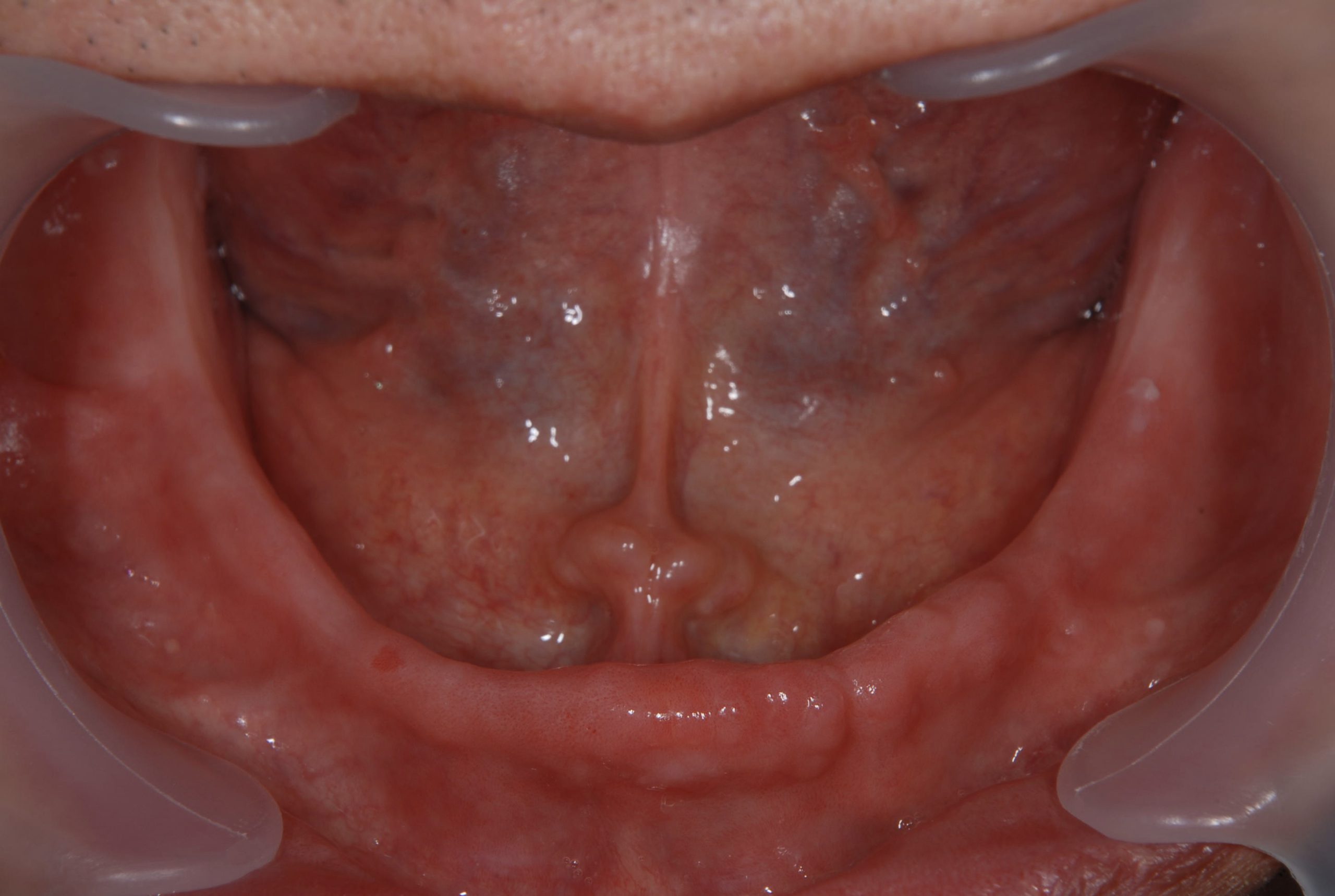 港南台パーク歯科クリニック｜【症例】歯周病で総入れ歯になった方へおすすめ！インプラントを用いた入れ歯治療｜治療前の下顎の写真２