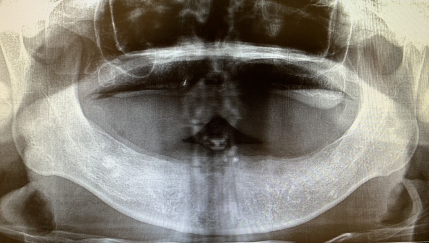 港南台パーク歯科クリニック｜【症例】歯周病で総入れ歯になった方へおすすめ！インプラントを用いた入れ歯治療｜治療前のレントゲン写真