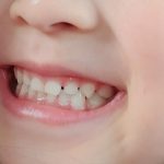 港南台パーク歯科クリニック｜ブログ｜MFT（口腔筋機能療法）とは？トレーニング法も紹介｜綺麗な歯並びの子供の画像