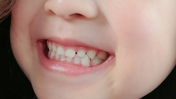 港南台パーク歯科クリニック｜ブログ｜MFT（口腔筋機能療法）とは？トレーニング法も紹介｜綺麗な歯並びの子供の画像