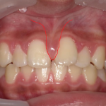 港南台パーク歯科クリニック｜【症例】子どもに多い上唇小帯付着異常の治療 ｜上唇小帯付着異常の写真