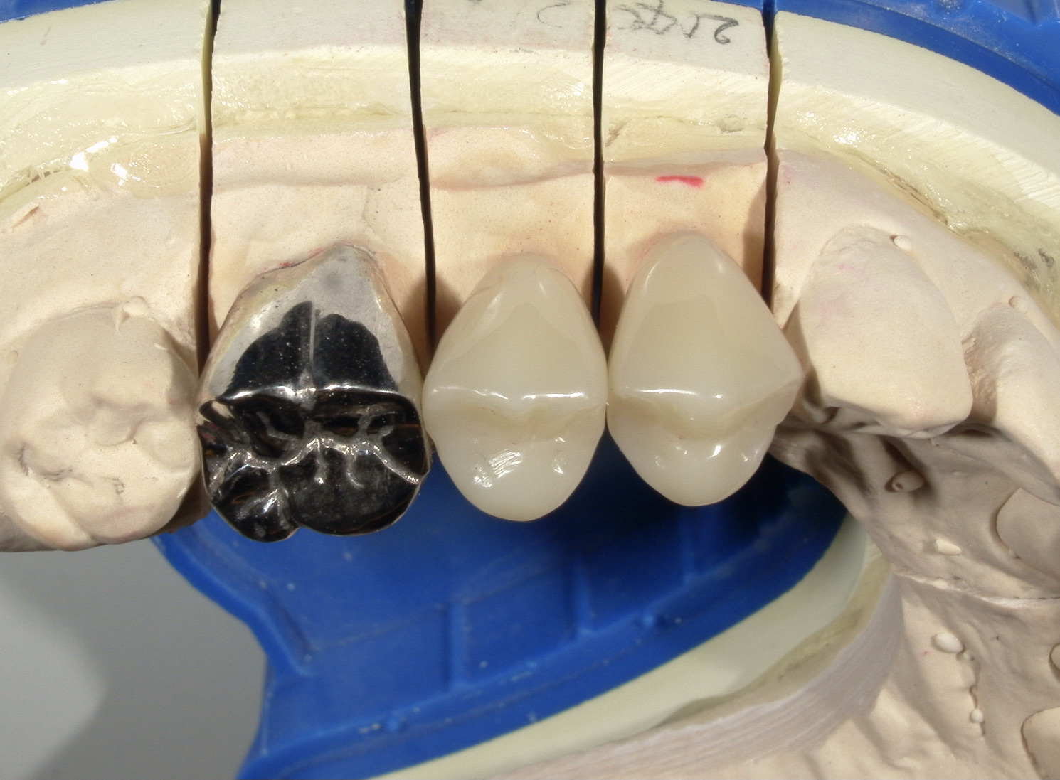 港南台パーク歯科クリニック｜【症例】保険診療で銀歯から白い歯へ｜被せ物（CAD/CAM冠）の写真