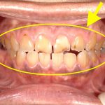 港南台パーク歯科クリニック｜ブログ|【症例】歯が溶ける「酸蝕症（さんしょくしょう）」とは？｜酸蝕症の前歯
