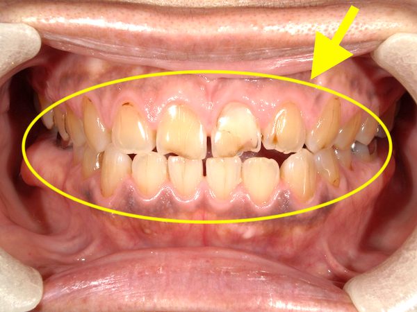 港南台パーク歯科クリニック｜ブログ|【症例】歯が溶ける「酸蝕症（さんしょくしょう）」とは？｜酸蝕症の前歯