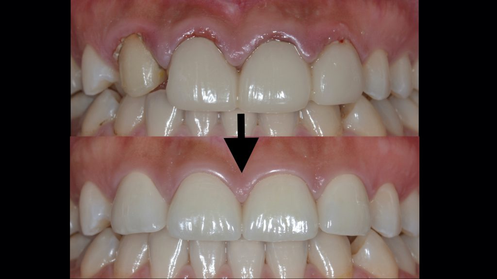 港南台パーク歯科クリニック｜【症例】他院でのセラミック治療で生じた歯肉炎が改善したケース｜治療前後の比較写真