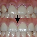 港南台パーク歯科クリニック｜【症例】他院でのセラミック治療で生じた歯肉炎が改善したケース｜治療前後の比較写真
