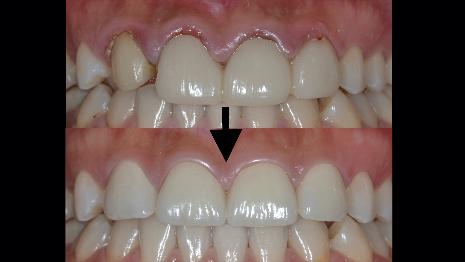 症例】他院でのセラミック治療で生じた歯肉炎が改善したケース｜港南台