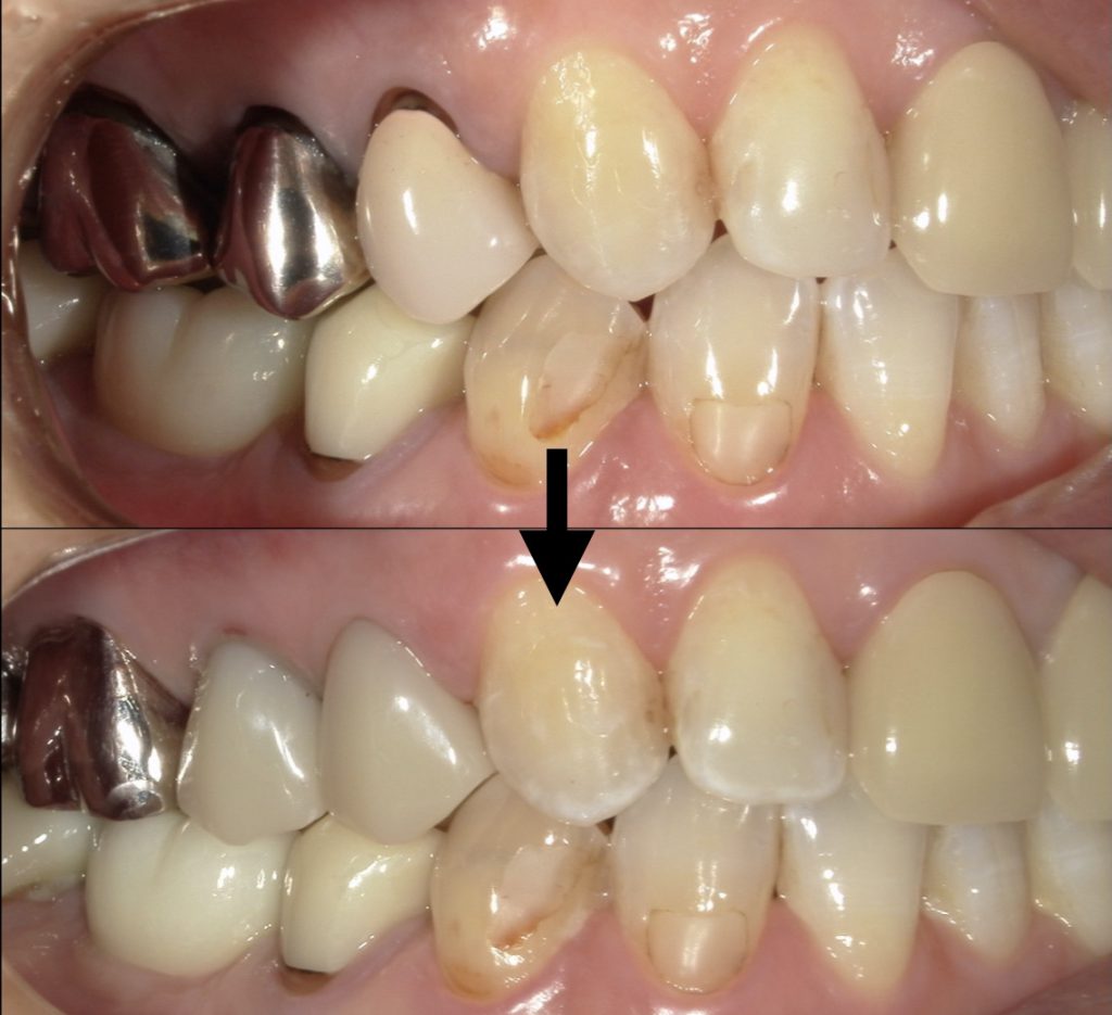 港南台パーク歯科クリニック｜【症例】保険診療で銀歯から白い歯へ｜治療前後の比較写真