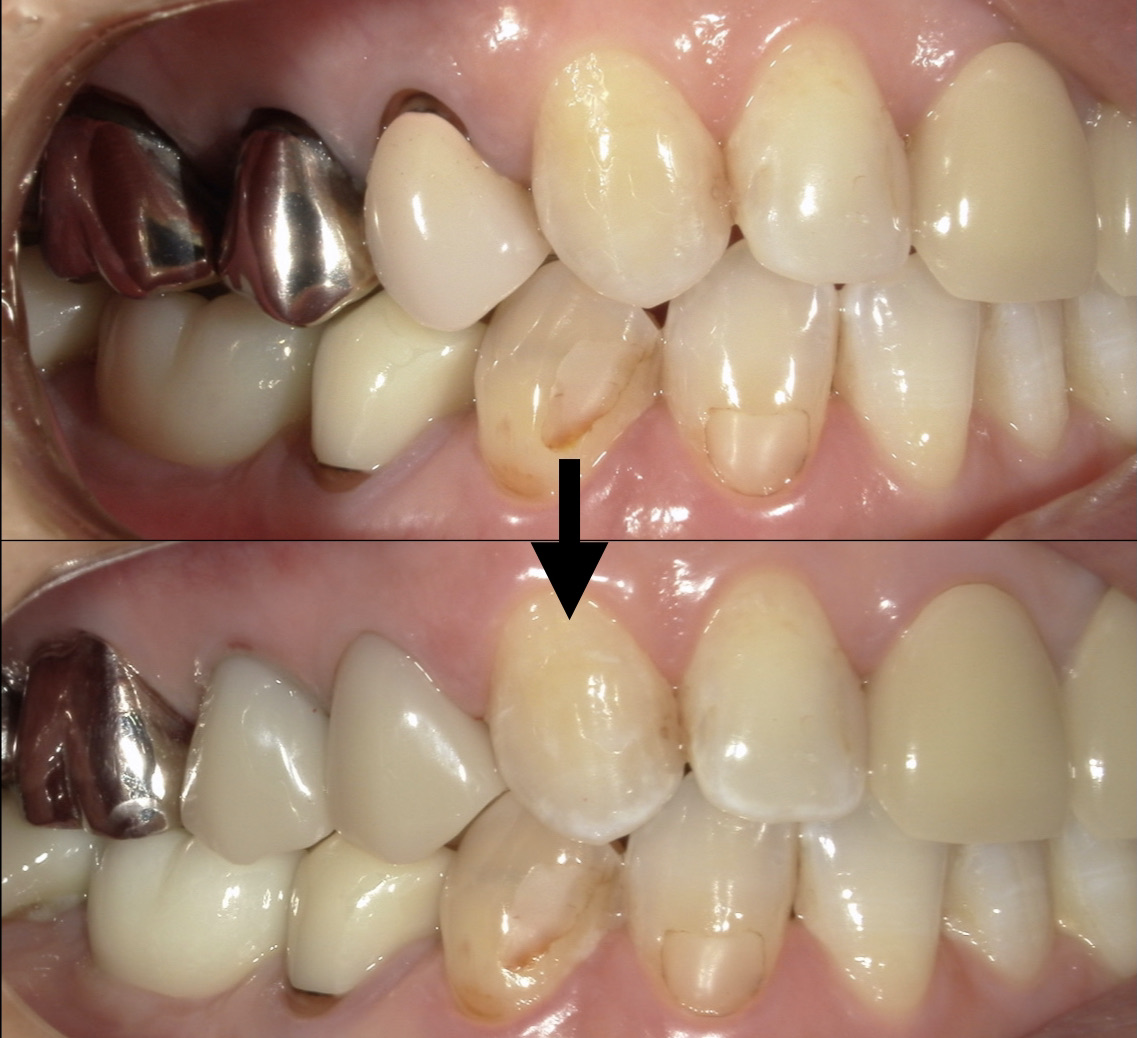 銀 歯 と 白い 詰め物 の 違い