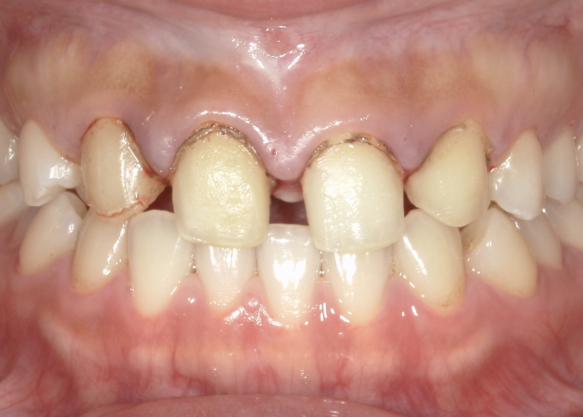 港南台パーク歯科クリニック｜【症例】他院でのセラミック治療で生じた歯肉炎が改善したケース｜古いラミネートベニアの除去、仮歯のセット２週間後の後の写真