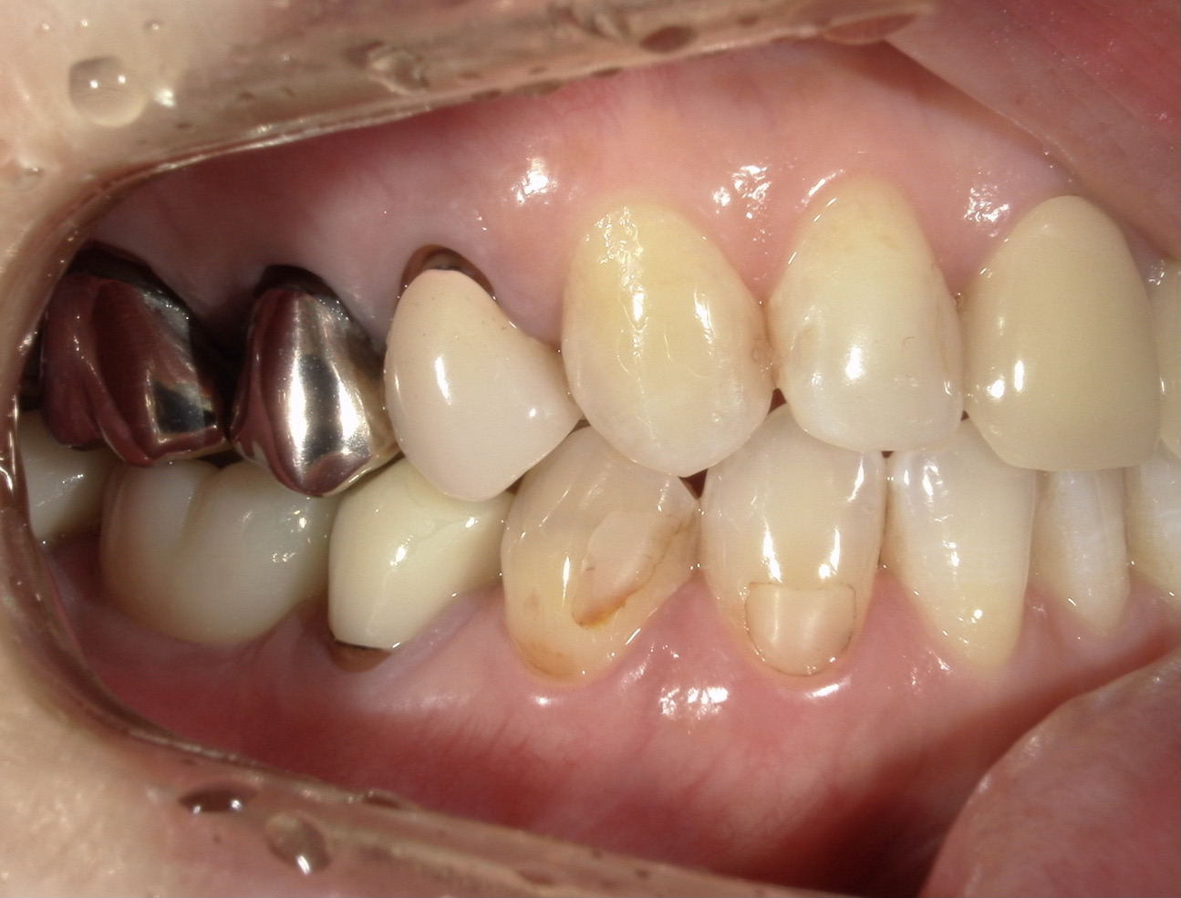 港南台パーク歯科クリニック｜【症例】保険診療で銀歯から白い歯へ｜治療前の口腔内写真