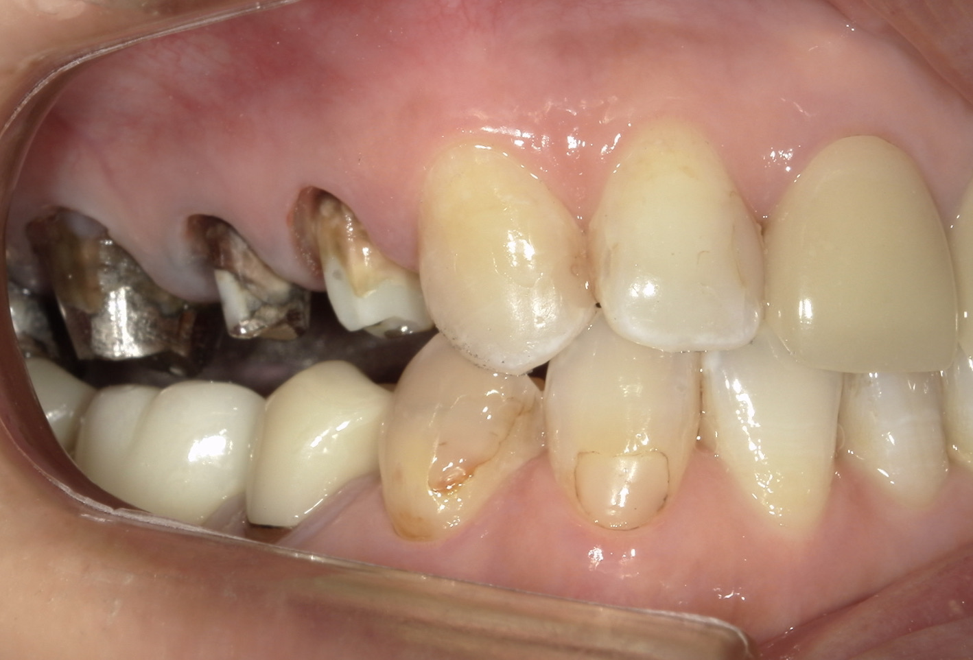 港南台パーク歯科クリニック｜【症例】保険診療で銀歯から白い歯へ｜金属の被せ物を外した後の写真