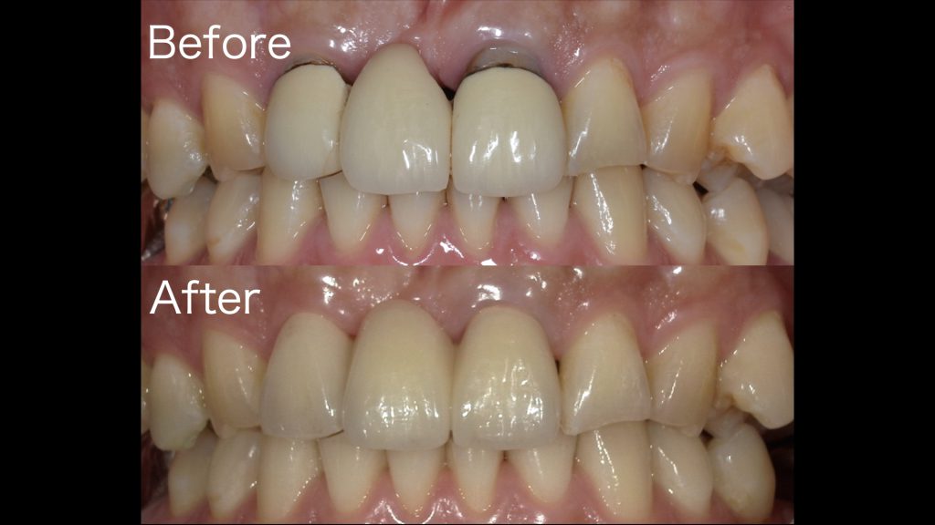 港南台パーク歯科クリニック｜【症例】ジルコニアセラミックによる前歯のブリッジ｜ビフォーアフター