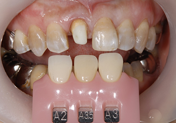 港南台の歯医者 港南台パーク歯科クリニック｜ブログ｜【症例】治療した歯がどれかわかりますか？繊細な色調を調整できる審美治療｜色合わせの画像