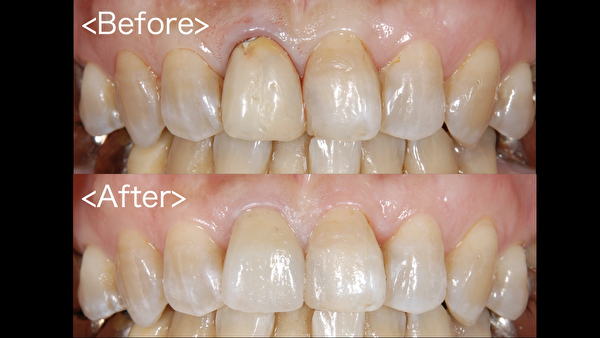 港南台の歯医者 港南台パーク歯科クリニック｜ブログ｜【症例】治療した歯がどれかわかりますか？繊細な色調を調整できる審美治療｜ビフォーアフター