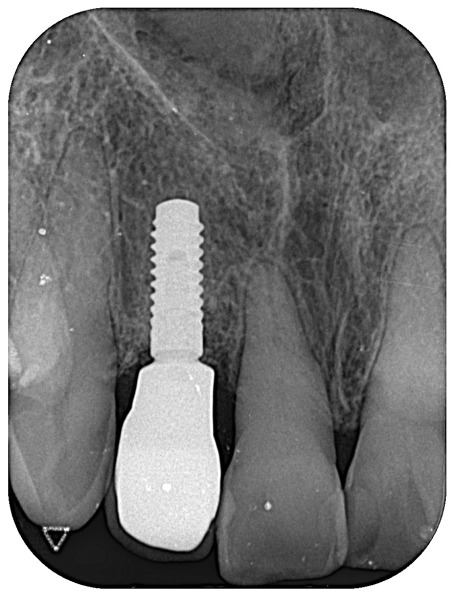 港南台の歯医者 港南台パーク歯科クリニック｜【症例】強くぶつけた前歯のインプラント治療｜最終補綴物装着時レントゲン画像