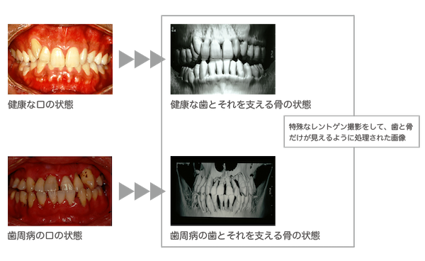 健康な口と、歯周病の口の比較画像｜歯は何からできているの？｜ブログ｜港南台パーク歯科クリニック