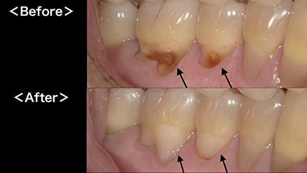 港南台の歯医者 港南台パーク歯科クリニック｜【症例】くさび状欠損(知覚過敏)の治療｜治療前後の画像