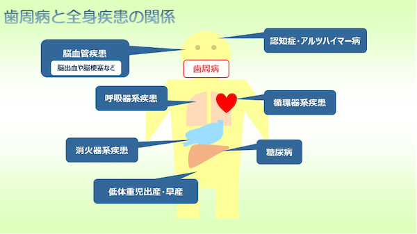 港南台パーク歯科クリニック｜ブログ｜歯科健診が義務化？歯科定期検診の必要性｜歯周病と全身疾患の関係の図