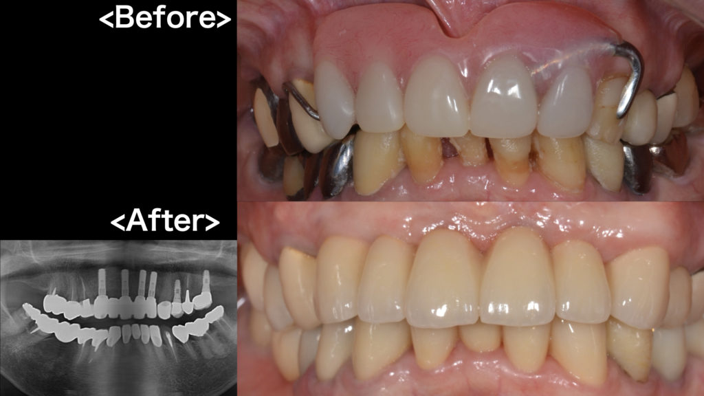 港南台の歯医者 港南台パーク歯科クリニック｜【症例】インプラントで美しい前歯に！｜アイキャッチ画像