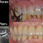 港南台の歯医者 港南台パーク歯科クリニック｜【症例】インプラントで美しい前歯に！｜アイキャッチ画像