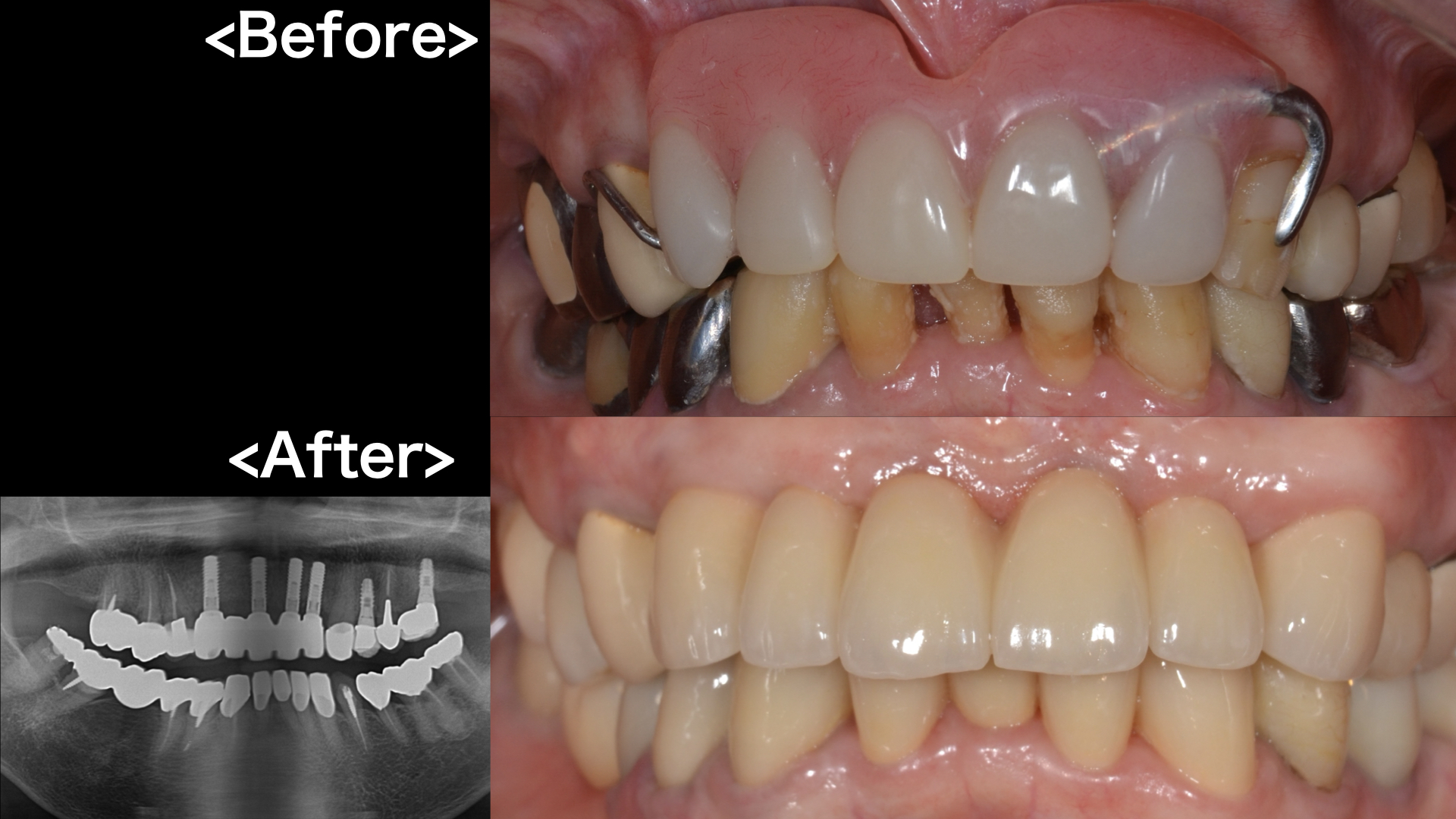 インプラント 前歯: 前歯 インプラント 難しい – DOBR