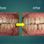 港南台パーク歯科クリニック｜症例｜中等度〜重度歯周病の治療からメンテナンスまで｜治療前後の比較画像