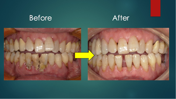 港南台パーク歯科クリニック｜症例｜中等度〜重度歯周病の治療からメンテナンスまで｜治療前後の比較画像