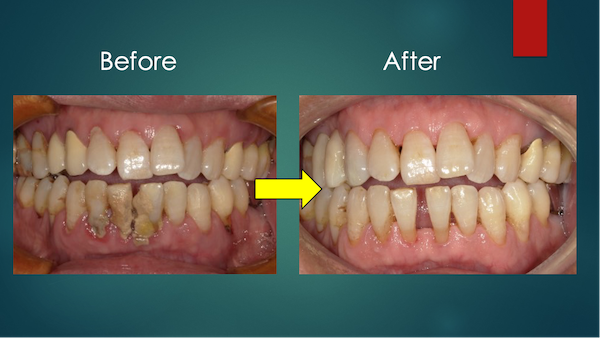 乾癬性関節炎の症状