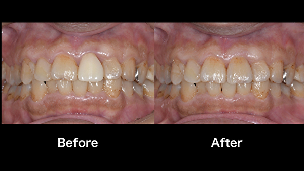 港南台の歯医者 港南台パーク歯科クリニック｜【症例】ジルコニアセラミックで見た目の色が自然な前歯に！｜アイキャッチ画像