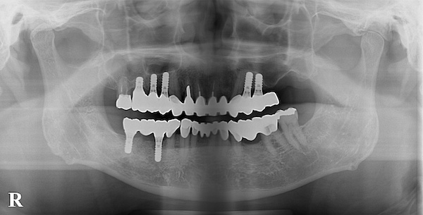 港南台パーク歯科クリニック｜症例｜コンピューターシミュレーションによる、より安心・安全なインプラント治療｜治療後の歯のレントゲン画像7