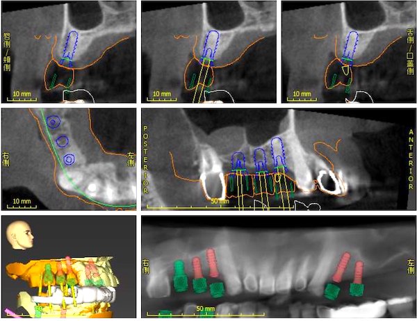 港南台パーク歯科クリニック｜症例｜コンピューターシミュレーションによる、より安心・安全なインプラント治療｜歯の治療計画の画像3