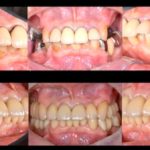 港南台パーク歯科クリニック｜症例｜コンピューターシミュレーションによる、安心・安全なインプラント治療｜アイキャッチ1