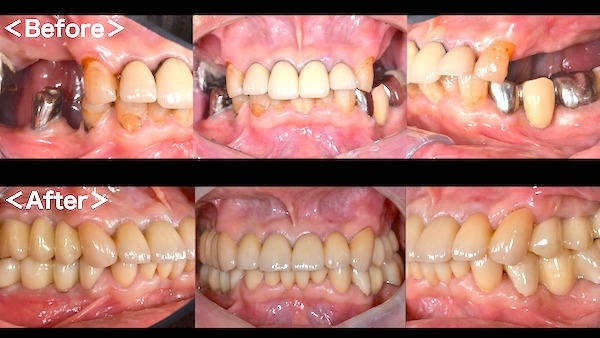 港南台パーク歯科クリニック｜症例｜コンピューターシミュレーションによる、安心・安全なインプラント治療｜アイキャッチ1
