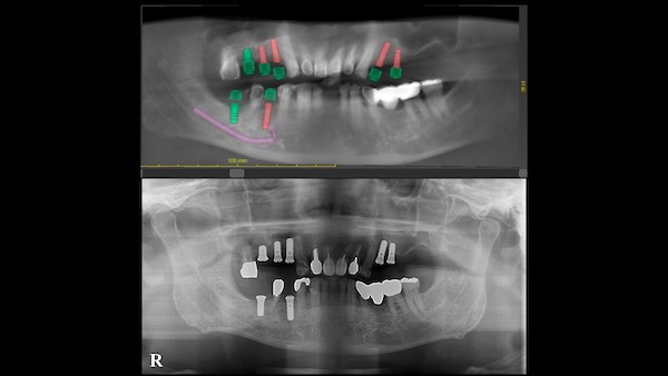 港南台パーク歯科クリニック｜症例｜コンピューターシミュレーションによる、より安心・安全なインプラント治療｜インプラント手術後の画像5