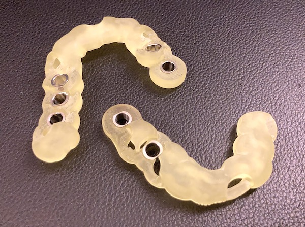港南台パーク歯科クリニック｜症例｜コンピューターシミュレーションによる、より安心・安全なインプラント治療｜サージカルガイドの画像4