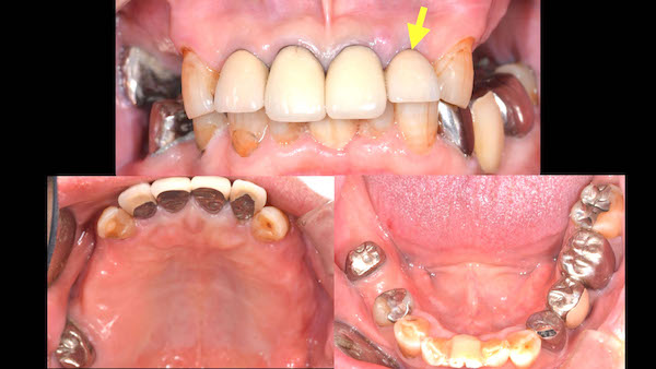 港南台パーク歯科クリニック｜症例｜コンピューターシミュレーションによる、より安心・安全なインプラント治療｜治療前の歯の画像2のコピー港南台パーク歯科クリニック｜症例｜コンピューターシミュレーションによる、より安心・安全なインプラント治療｜治療前の歯の画像2