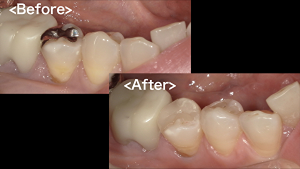 港南台パーク歯科クリニック｜【症例】銀歯からセラミック（e-max）への審美治療で見た目を改善｜治療前後の画像