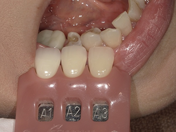 港南台パーク歯科クリニック｜【症例】銀歯からセラミック（e-max）への審美治療で見た目を改善｜シェードテイキングの画像