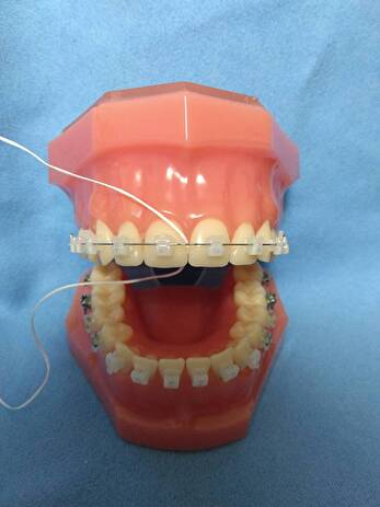 港南台パーク歯科クリニック｜ブログ｜ブラケットによる矯正治療中のセルフケアの方法についてご紹介｜ブラケットのフロスの画像2