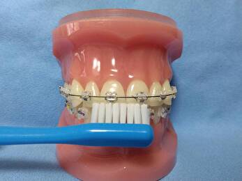 港南台パーク歯科クリニック｜ブログ｜ブラケットによる矯正治療中のセルフケアの方法についてご紹介｜ブラケットの歯磨きの画像2